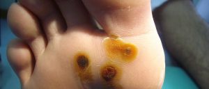 Verruga plantar o papiloma plantar