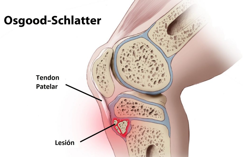 La lesión Osgood-Schlatter